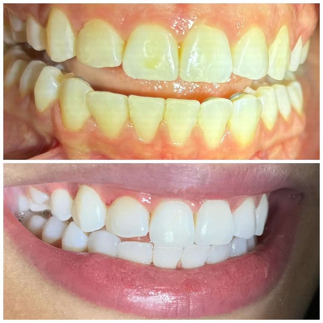 Antes e depois — caso 1