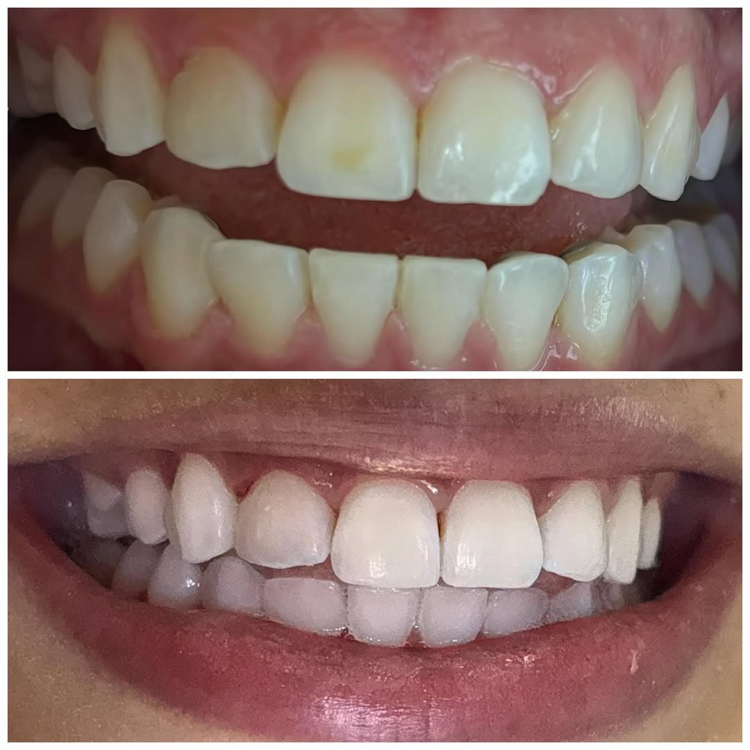 Antes e depois — caso 2