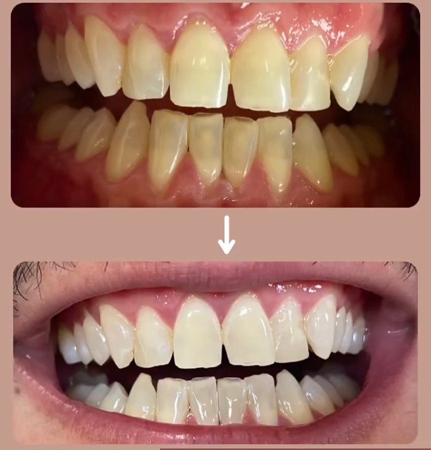 Antes e depois — caso 4