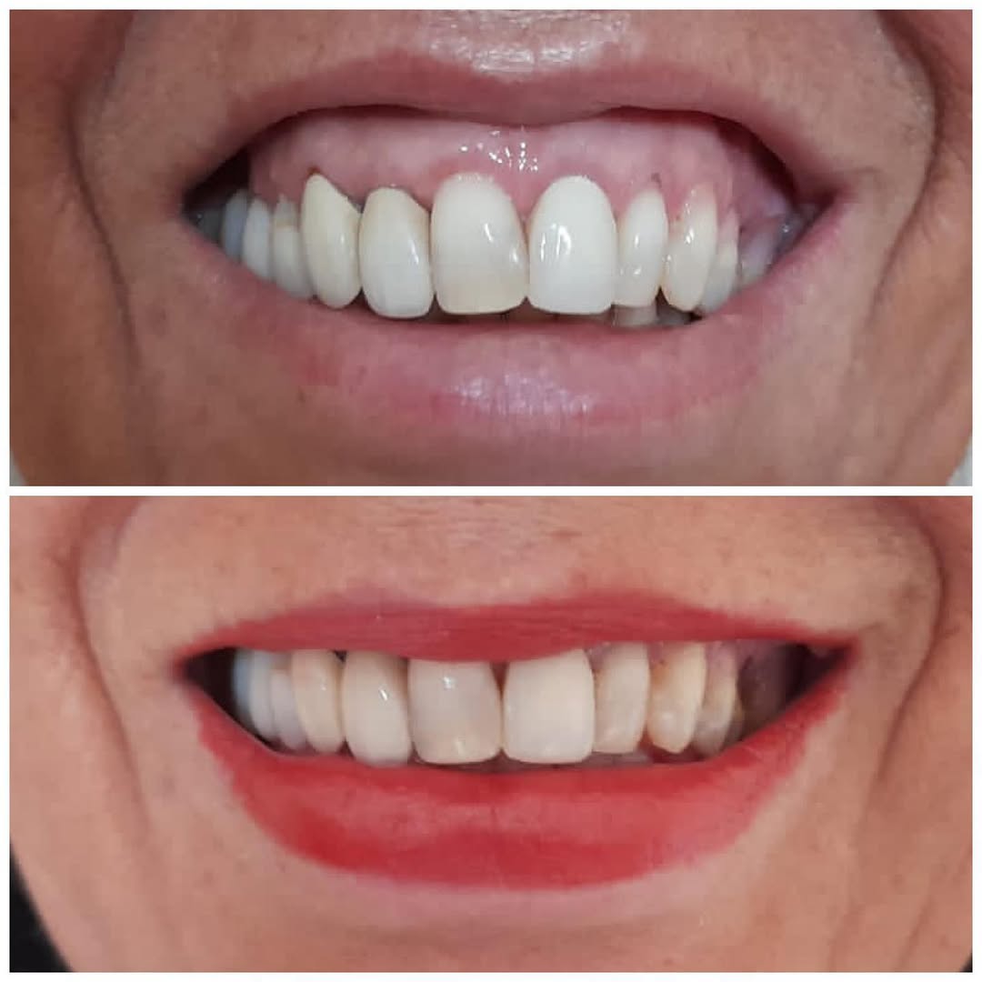 Antes e depois — caso 5