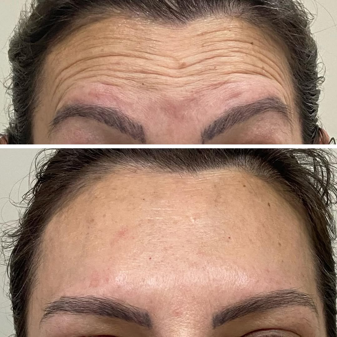 Antes e depois — harmonização orofacial (toxina botulínica)