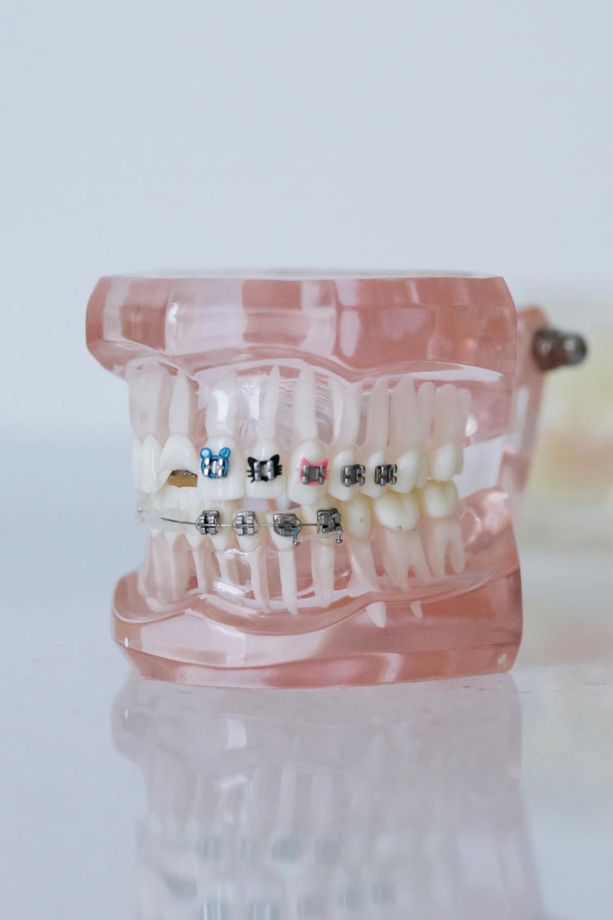 Ortodontia — aparelho fixo para alinhamento dental
